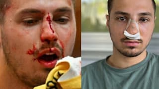 Handball-Schock in Österreich: Horvat schlägt Mahr brutal ins Gesicht