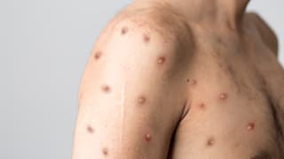 Mpox: WHO ruft wegen „Affenpocken“-Variante weltweite Notlage aus 
