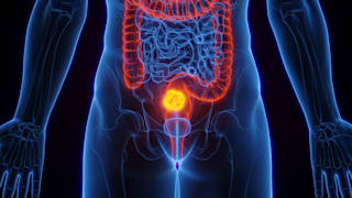Coli-Bakterien könnten Auslöser für Darmkrebs sein