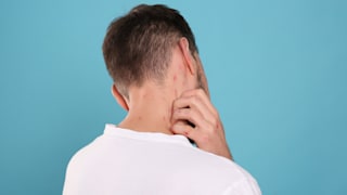 Mpox-Virus: Muss ich mir Sorgen machen wegen Affenpocken?